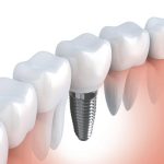 Implanty zębów przeciwwskazania