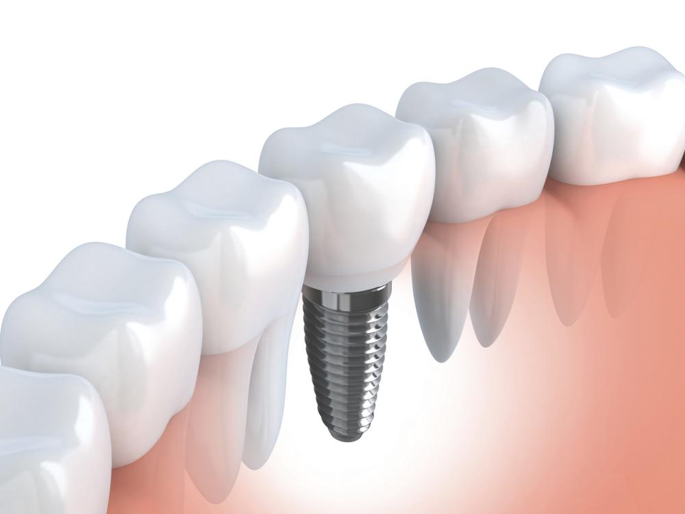 Implanty zębów przeciwwskazania