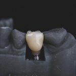 Szczecin implanty zębów